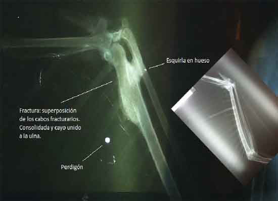 rx-fractura